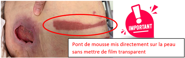 Proc dure De Soin Th rapie Par Pression N gative TPN VAC THERAPY proc-dure-de-soin-th-rapie-par-pression-n-gative-tpn-vac-therapy